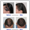 Before after from Phyllotex Vitamin Hair Regreowth Study